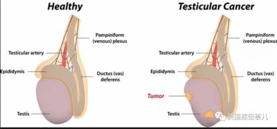 13年前，我如日中天... 直到醫生跟我說，我的一個蛋得了睾丸癌...